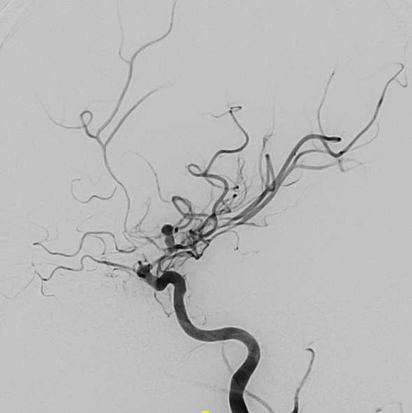 Figure 2. Digital subtraction angiography (AP view) demonstrating bilobed left ICA bifurcation aneurysm with severe vasospasm involving the supraclinoid ICA, ACA, and MCA.